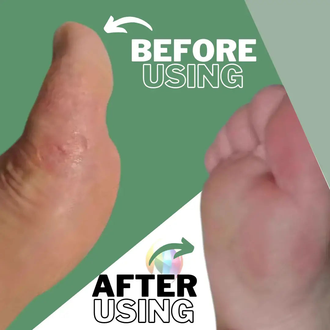 Before And After Using Feet Corn Removal Serum